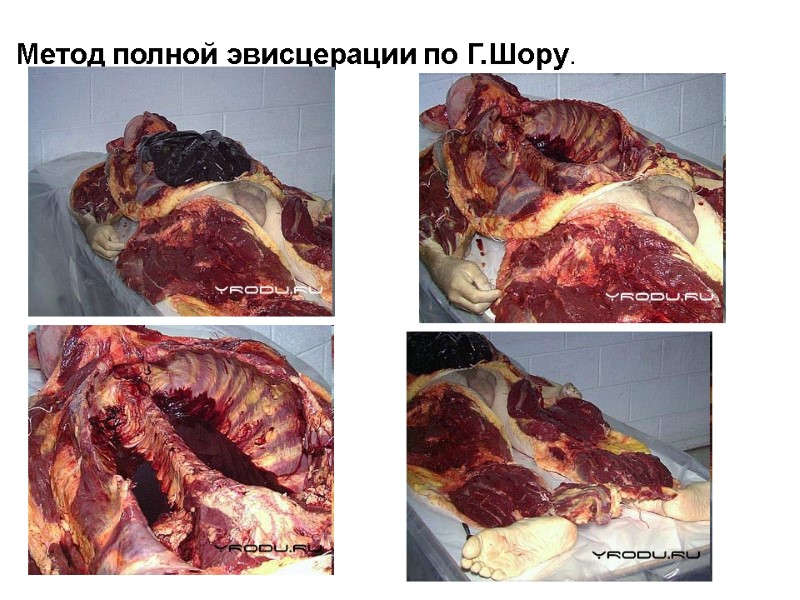 Метод полной эвисцерации по Г.Шору.